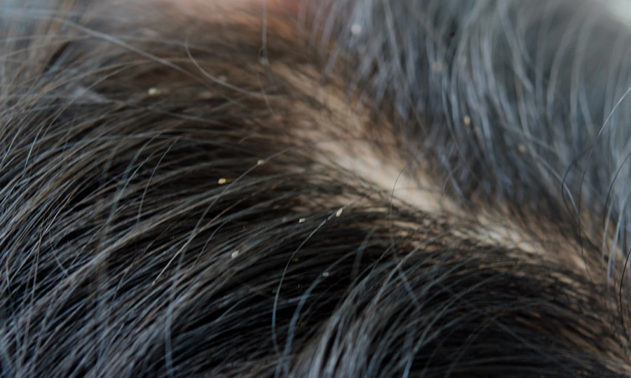 頭屑過多可能影响生髮