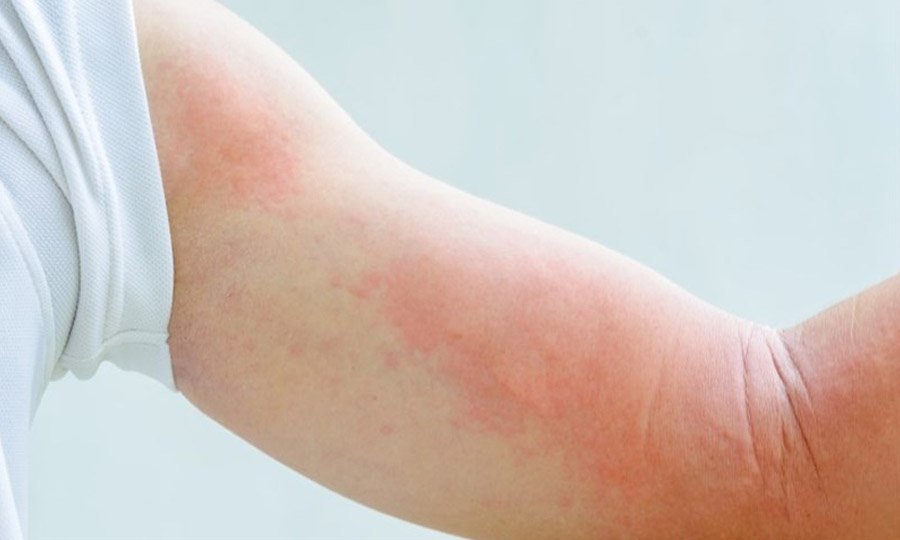 【濕疹全攻略】濕疹（eczema）是一種慢性、炎症性、瘙癢性皮膚病，皮疹呈多形性，明顯瘙癢，慢性病程。
